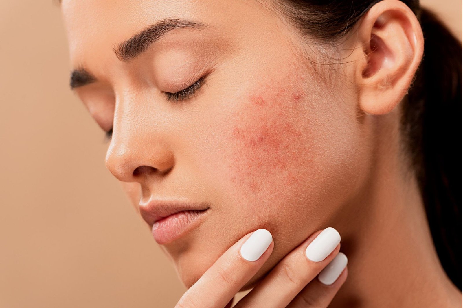 Eczema: Common Symptoms, Causes & Natural Remedies_3