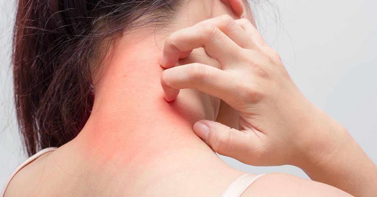 Eczema: Common Symptoms, Causes & Natural Remedies_4